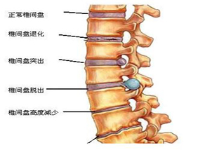 腰椎间盘突出症症状  常识